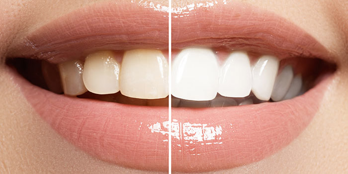 Teeth Whitening Hismile vs Zoom - Which Is Better?