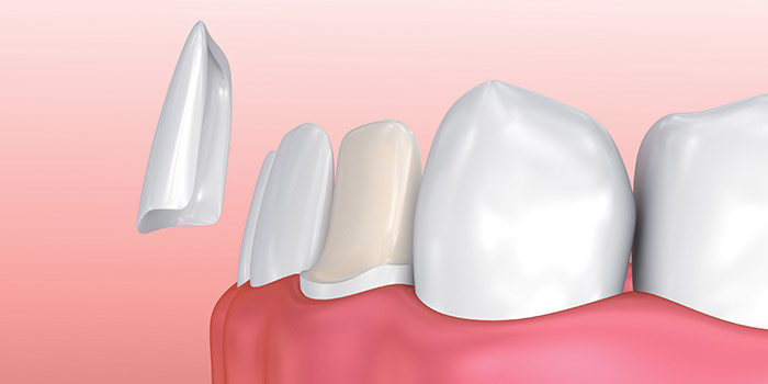 Porcelain Veneer Tooth Process