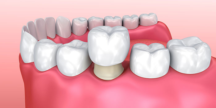 same-day dental crowns on teeth