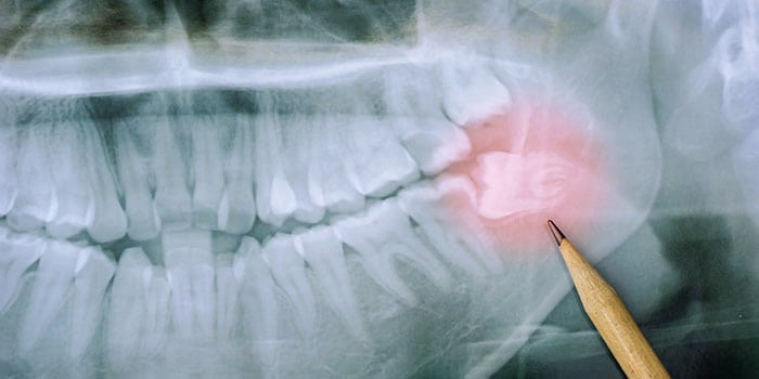 Panoramic X-Ray of Teeth