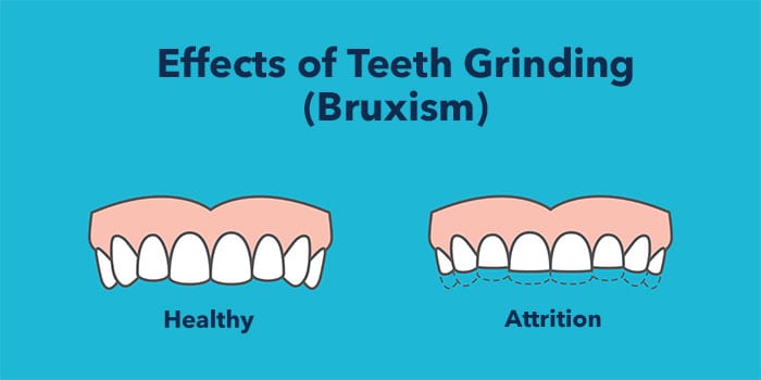 effects of teeth grinding bruxism graphic healthy teeth attrition