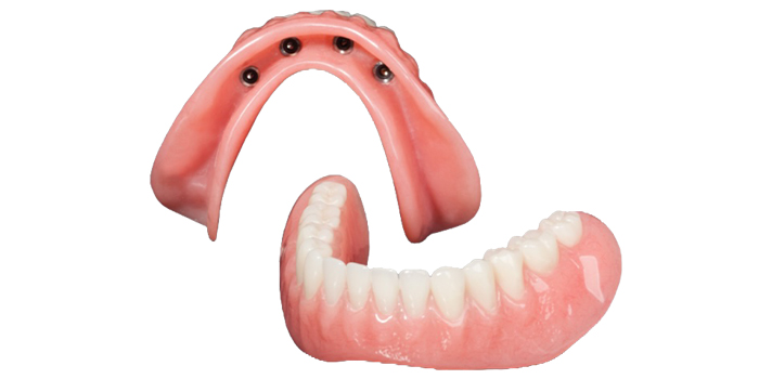 OverDenture