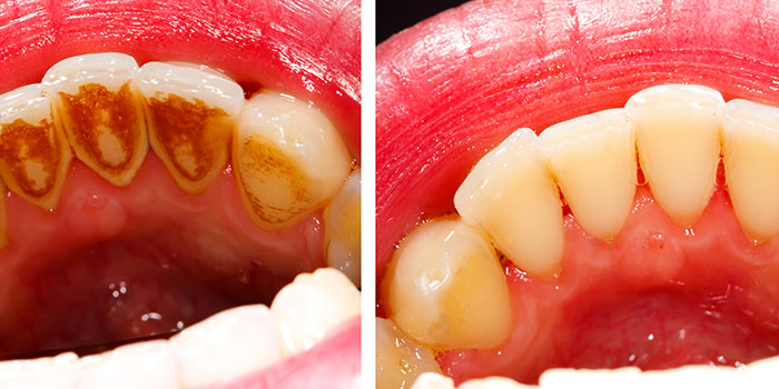 tartar buildup before and after dentist