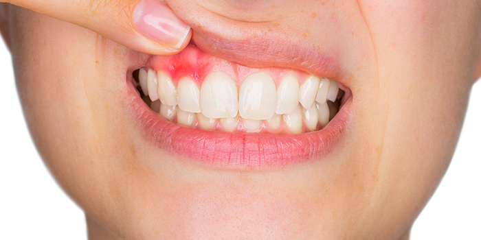 Gum Disease Signs Symptoms Red Gums