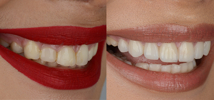 before and after photo of a patient with a gum lift following a smile makeover procedure