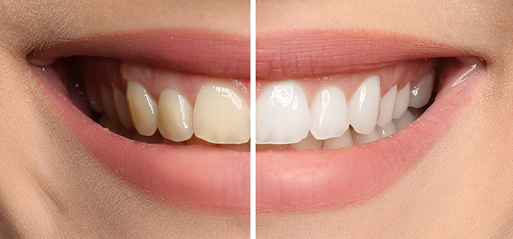 cosmetic dentistry teeth whitening before and after