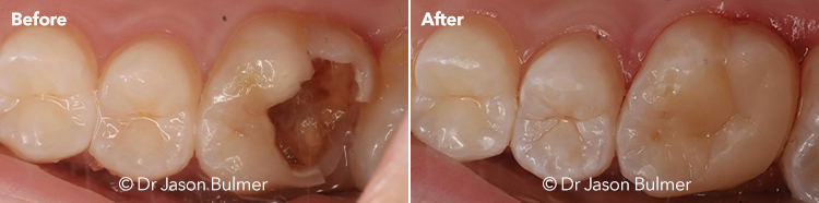 How Long After A Filling Can I Eat Coastal Dental Care