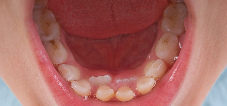 Child teeth with decay