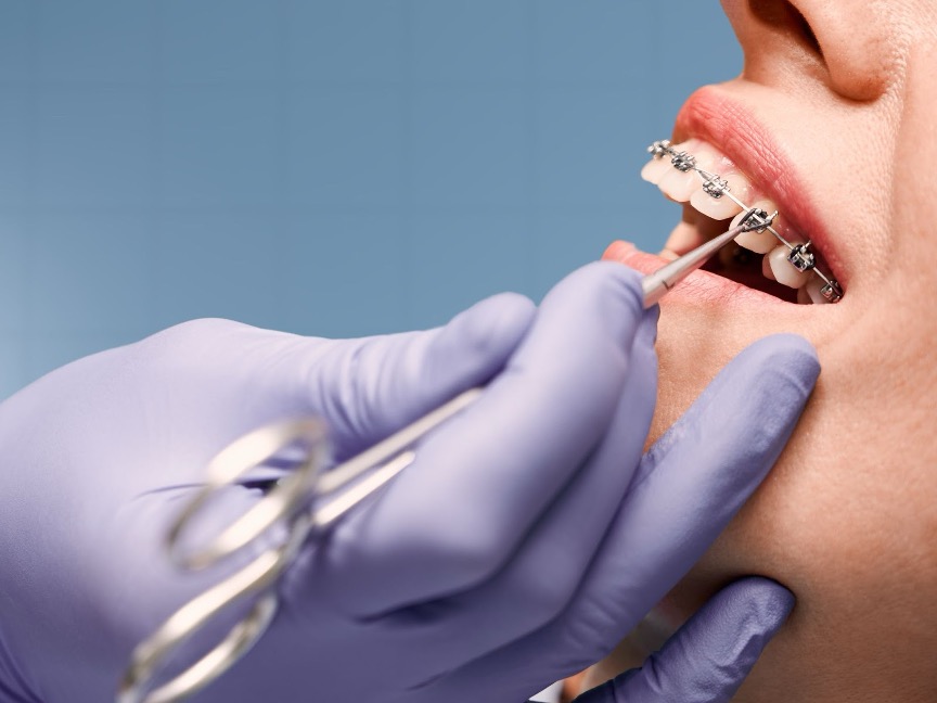 Braces vs Invisalign