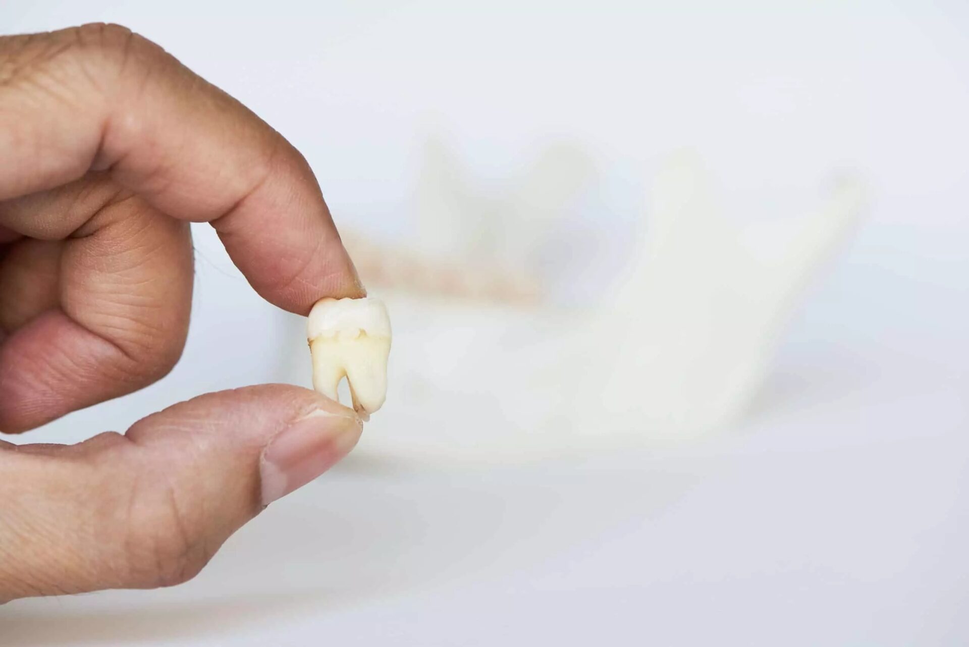 Removing All 4 Wisdom Teeth: What You Need to Know