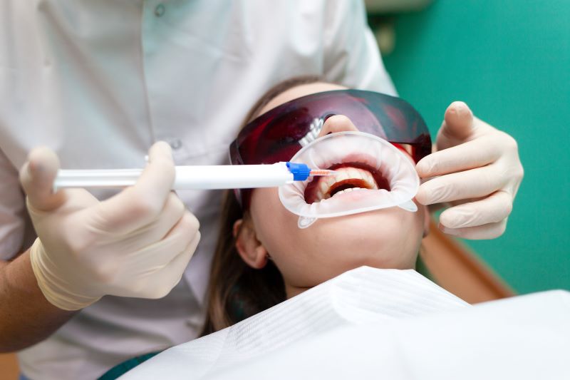 In Chair Teeth Whitening vs. At Home Kits