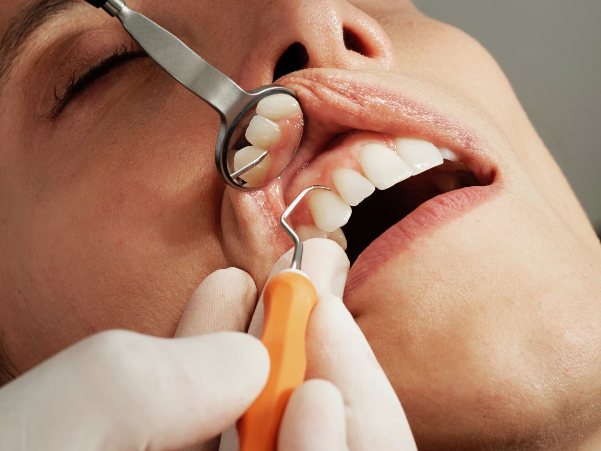 Gum Disease Treatment Gold Coast